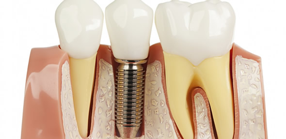 Types of implants & techniques