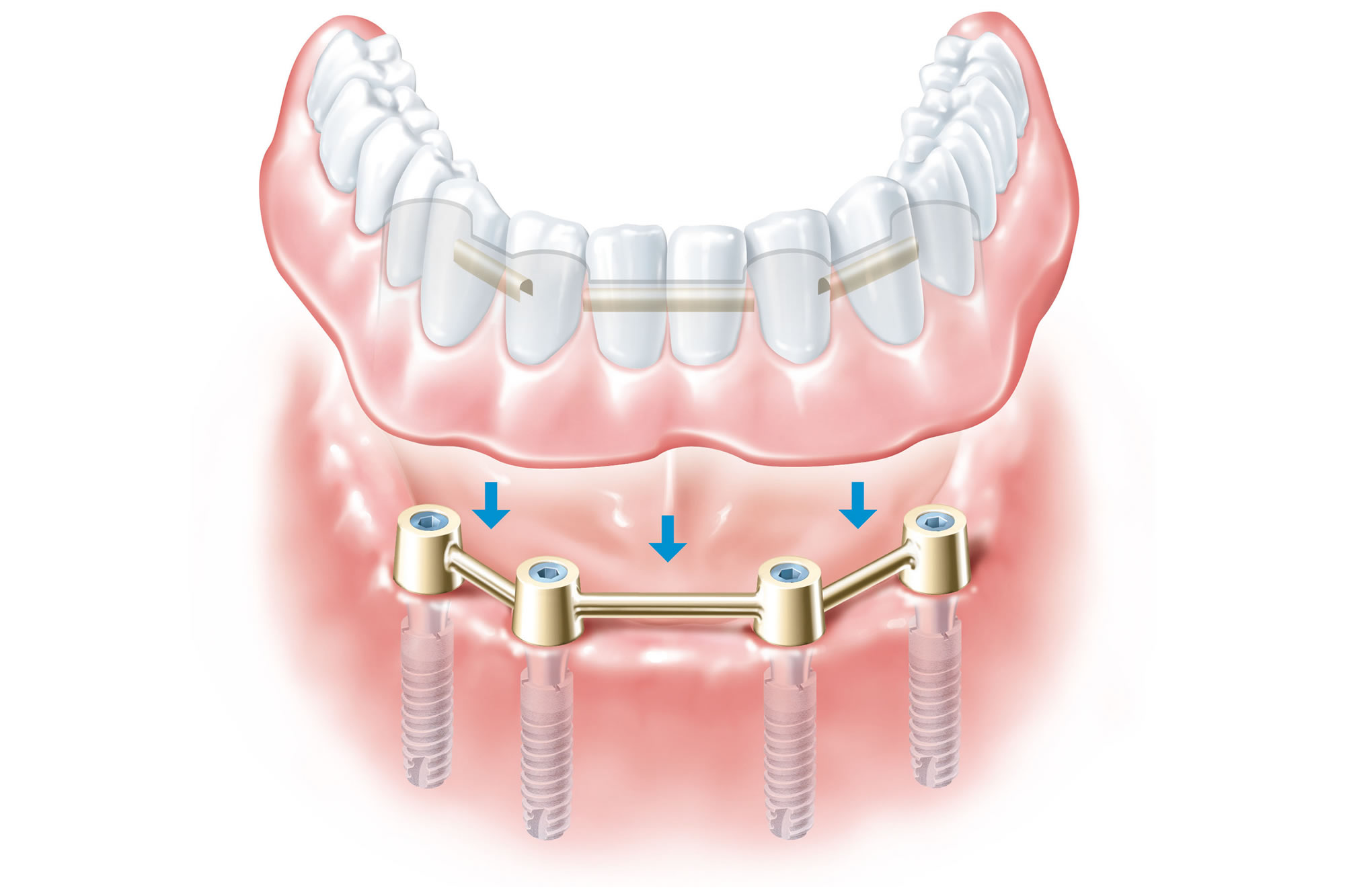 ALL-ON-4 DENTAL IMPLANTS